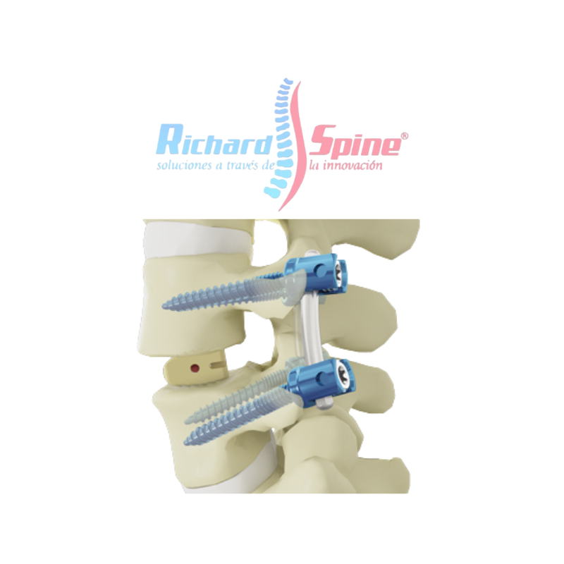 Caja de Fusión Intercorporal Torácica y Lumbar (PLIF)