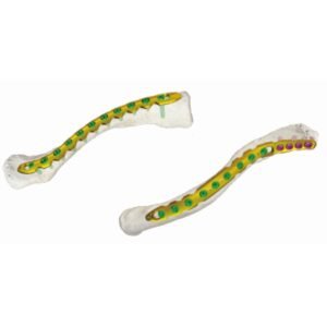 Sistema de placa de bloqueo de clavícula VA